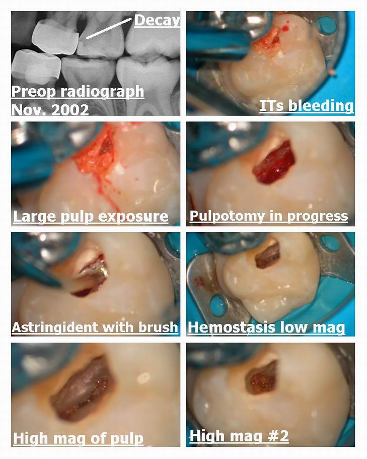 Pulpotomy pg 1.jpg